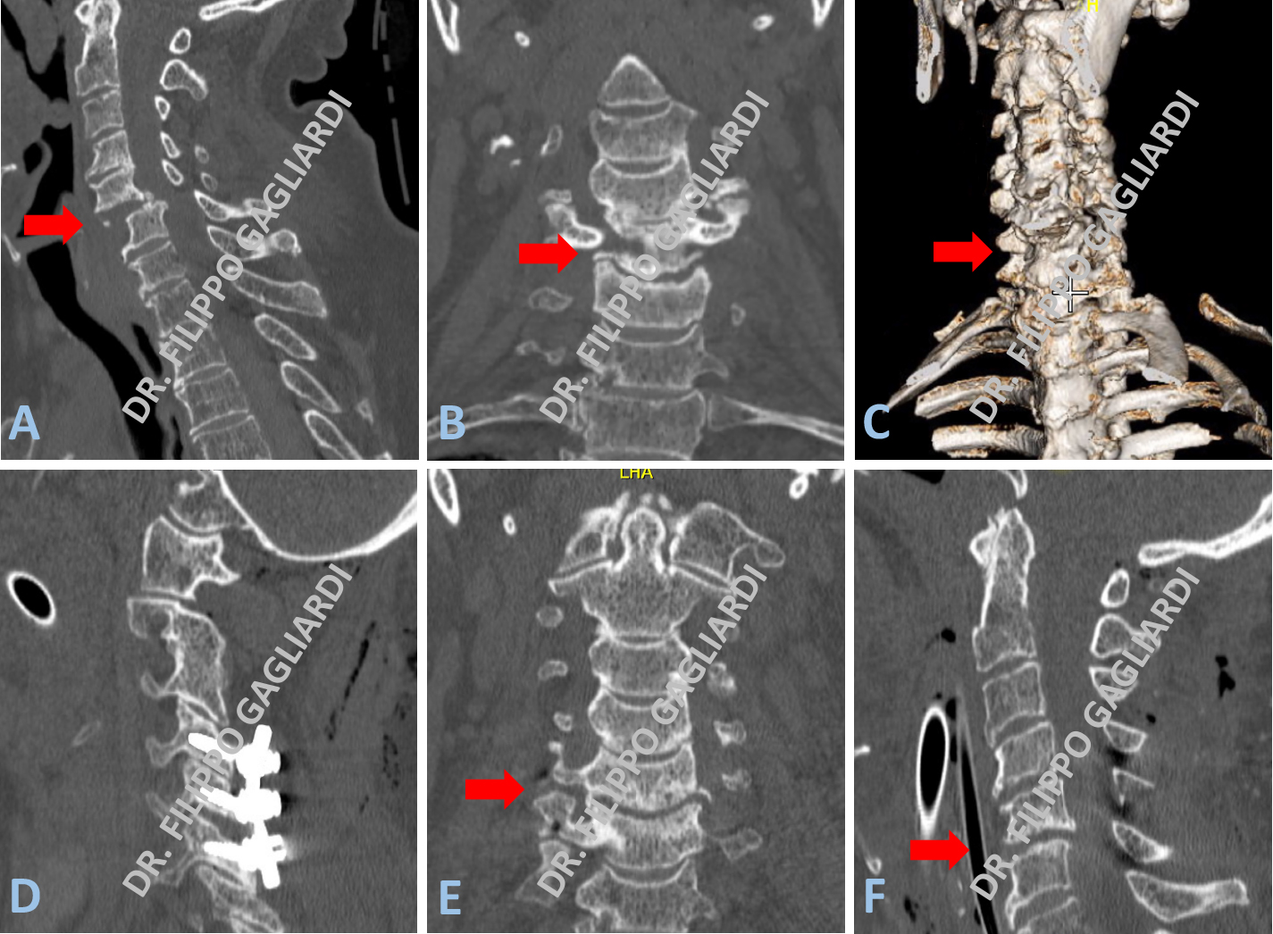 stabilizzazione cervicale