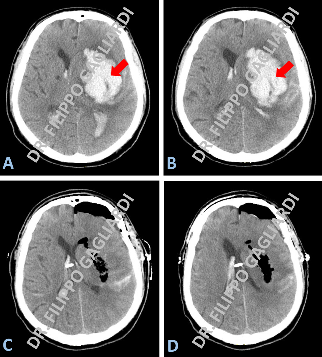 emorragie cerebrali