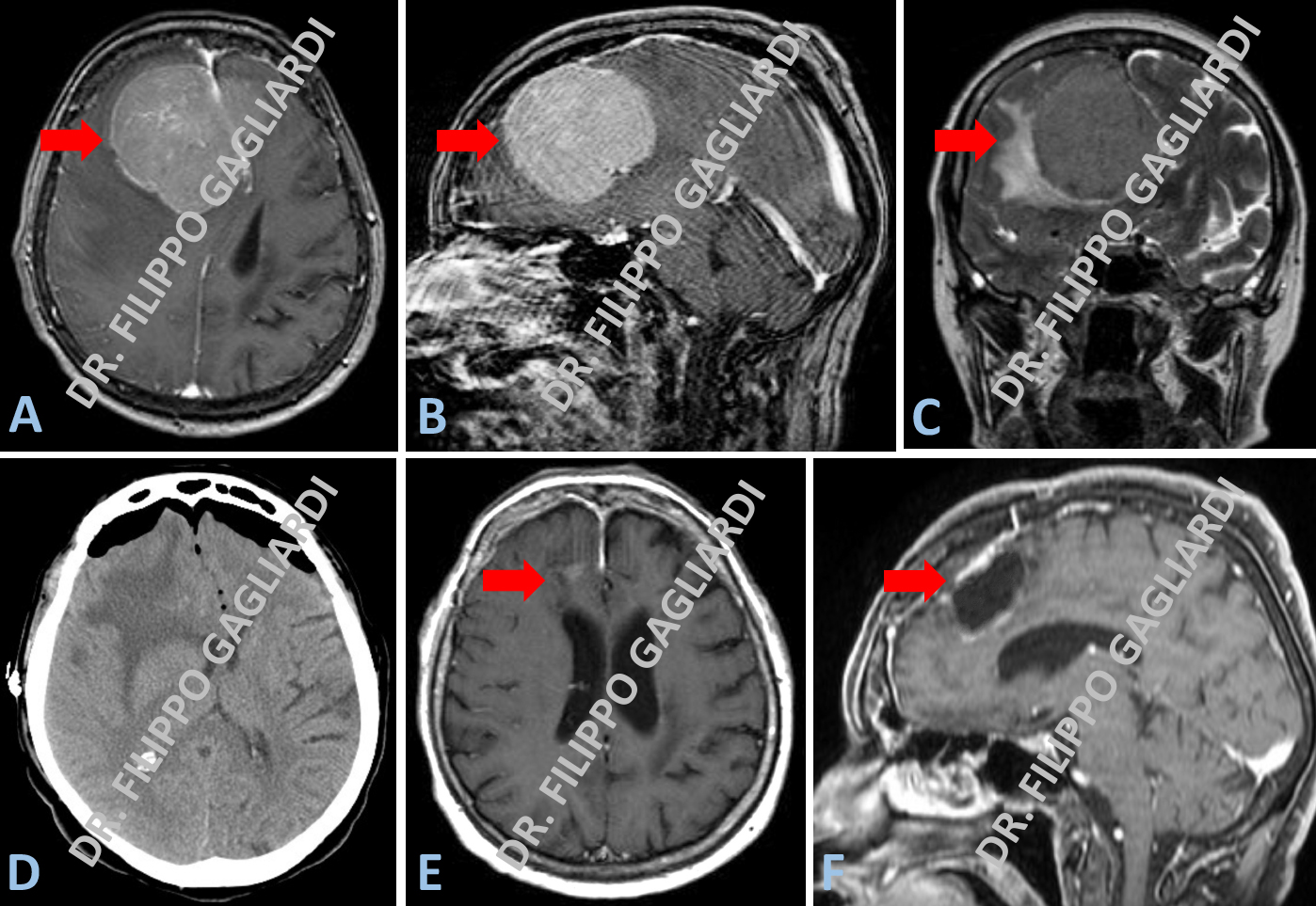 Tumori Delle Meningi Meningiomi Dott Filippo Gagliardi Neurochirurgo