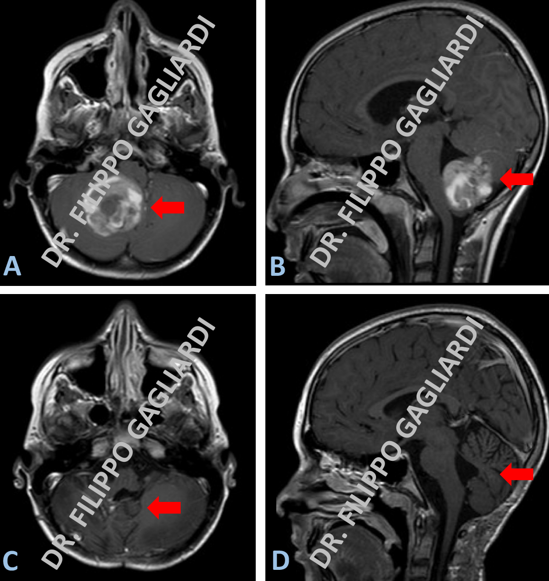 tumore del cervelletto