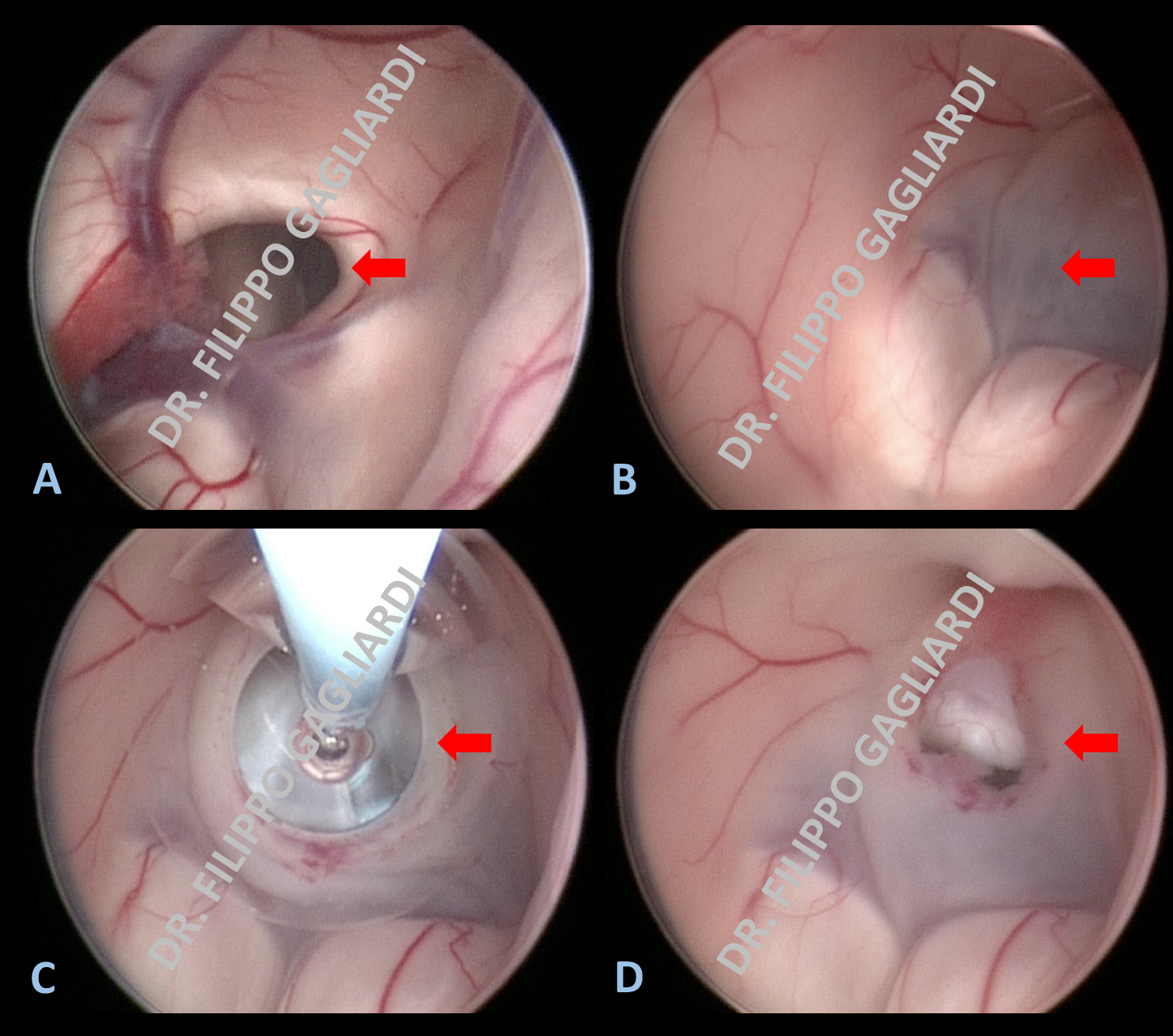 tecnica endoscopica