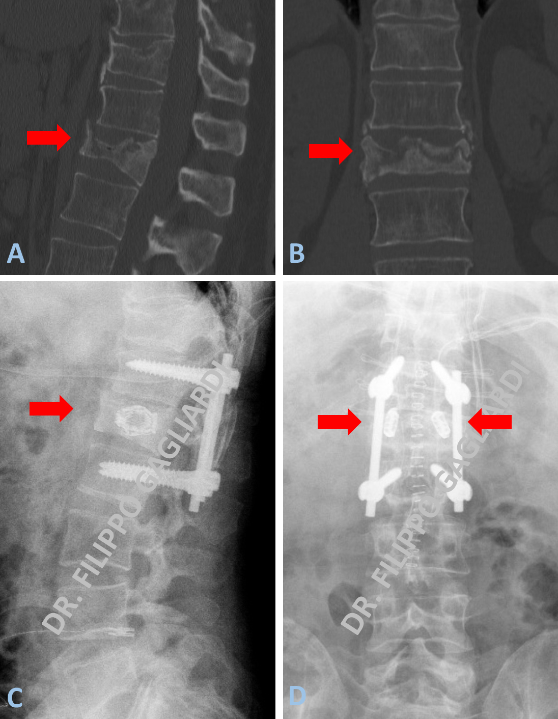 Patologie traumatiche del rachide lombare