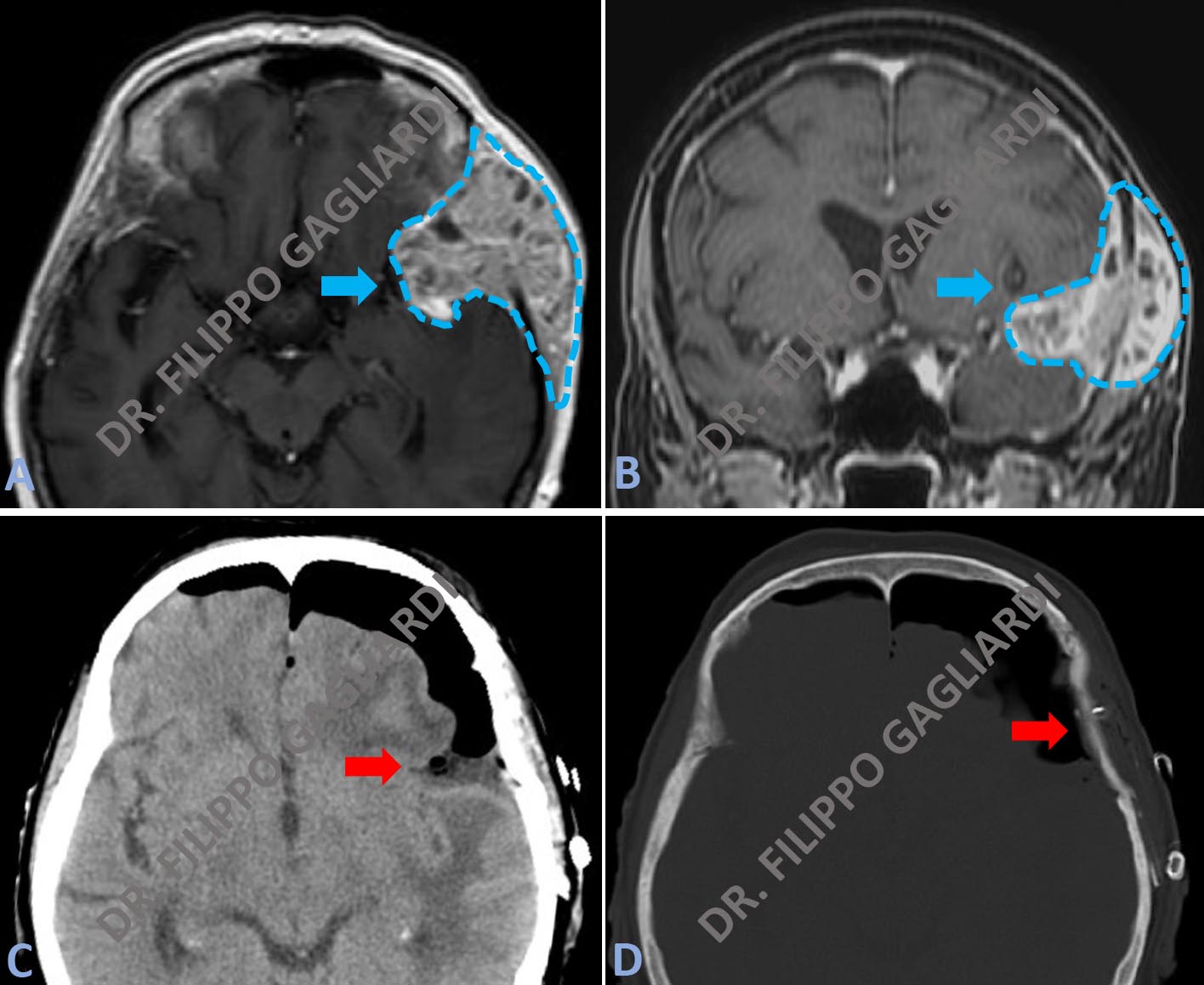 Craniotomia 