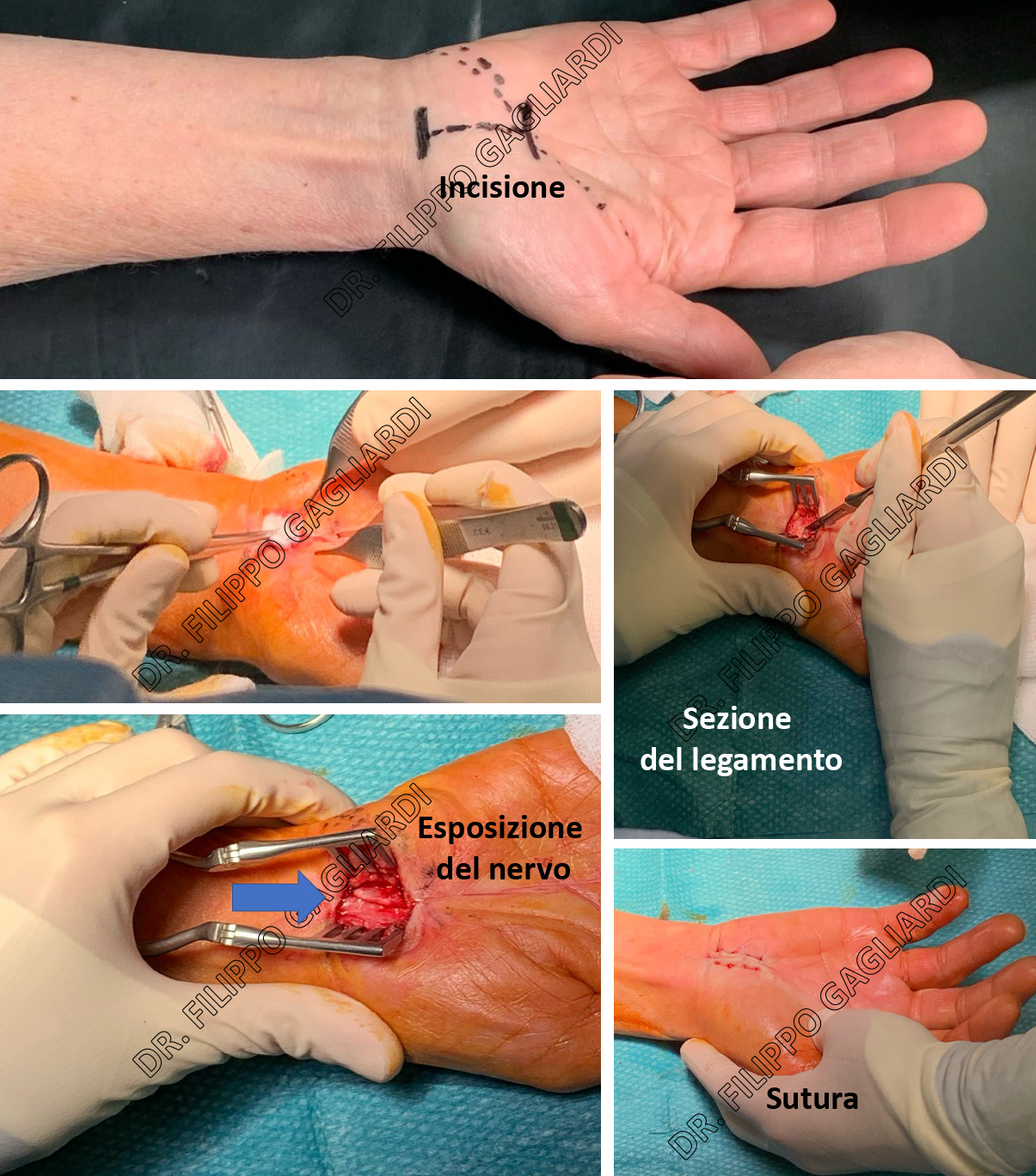 Neuropatie compressive periferiche