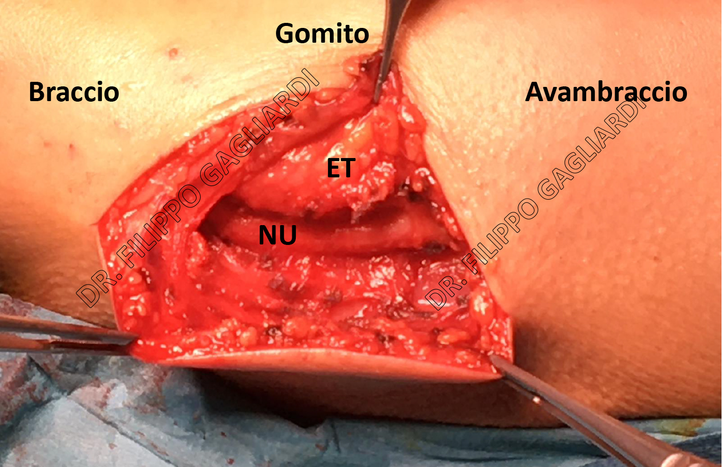 Neuropatie compressive periferiche